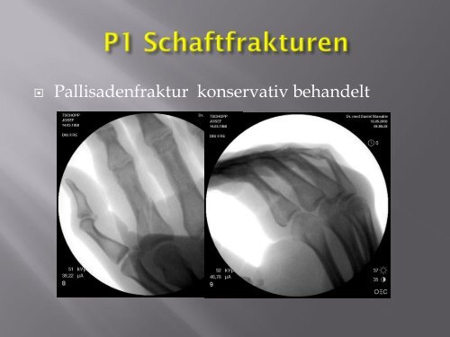 Frakturen des Handskelettes (PDF, 5.6MB)