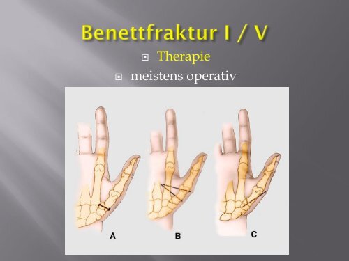 Frakturen des Handskelettes (PDF, 5.6MB)