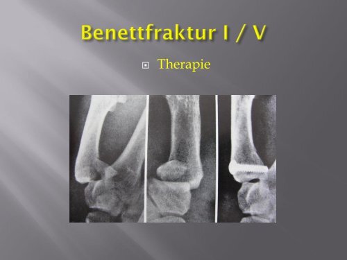 Frakturen des Handskelettes (PDF, 5.6MB)