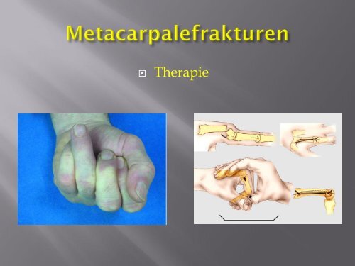 Frakturen des Handskelettes (PDF, 5.6MB)