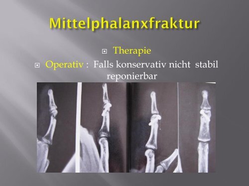 Frakturen des Handskelettes (PDF, 5.6MB)