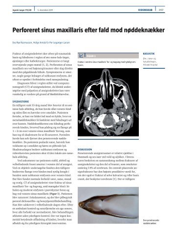 Perforeret sinus maxillaris efter fald mod nøddeknækker