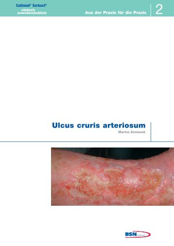 Ulcus cruris arteriosum - Cutimed Sorbact