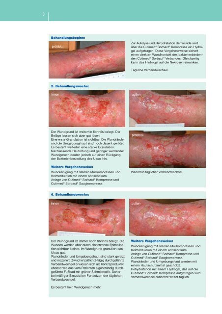 Ulcus cruris arteriosum - Cutimed Sorbact