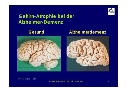 Alzheimer Demenz - Was gibt es Neues? - Praxis Dr.med. Briesenick