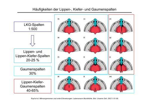 Entstehung und Vorbeugung LKG - Universitätsklinikum Erlangen