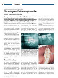 Die autogene Zahntransplantation - MKG-Praxisklinik