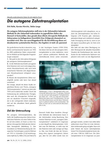 Die autogene Zahntransplantation - MKG-Praxisklinik