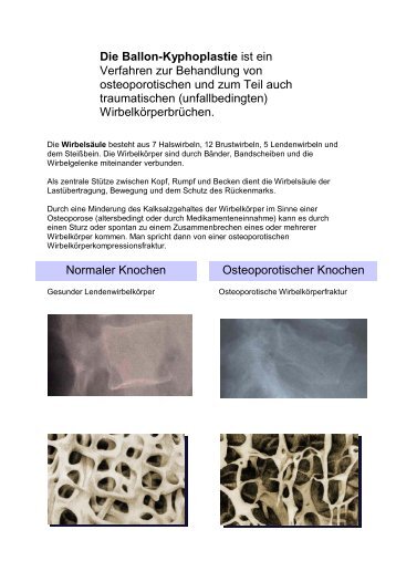 Kyphoplastie - Klinikum Friedrichshafen GmbH