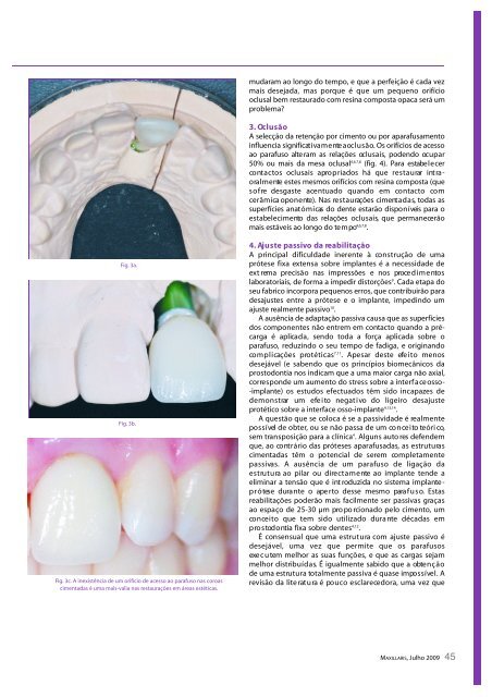 Prótese fixa sobre implantes: cimentar ou ... - Miguel Stanley