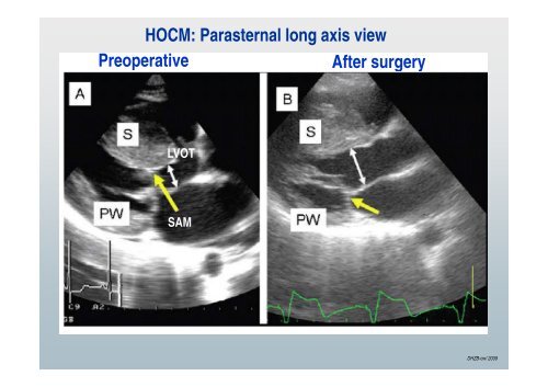 Mitral Valve Repair in Children