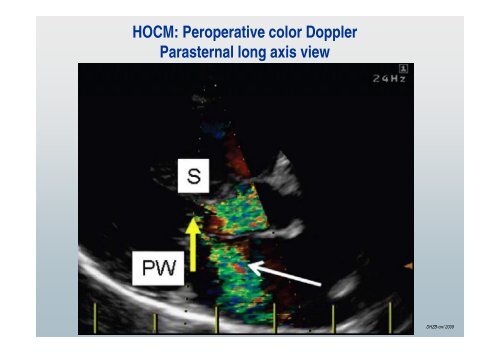 Mitral Valve Repair in Children