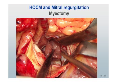 Mitral Valve Repair in Children