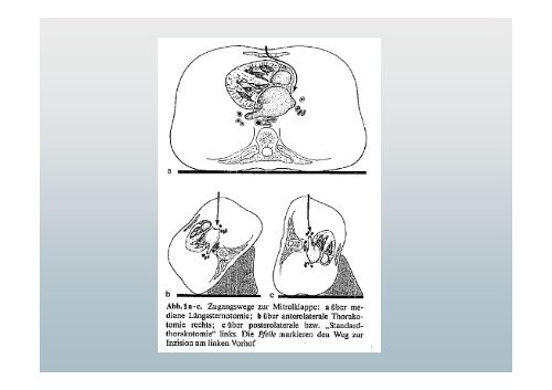 Mitral Valve Repair in Children