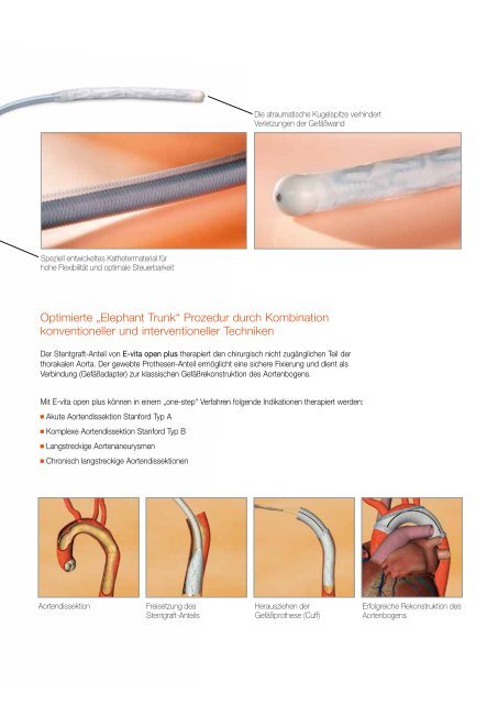 Das endoluminale Stentgraft-System für die Herzchirurgie ...