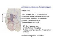 Amnesie und medialer Temporallappen Patient HM: 1953, im Alter ...