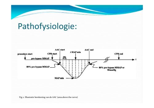 Vasoplegie tijdens cardiopulmonale bypass - UZ Leuven