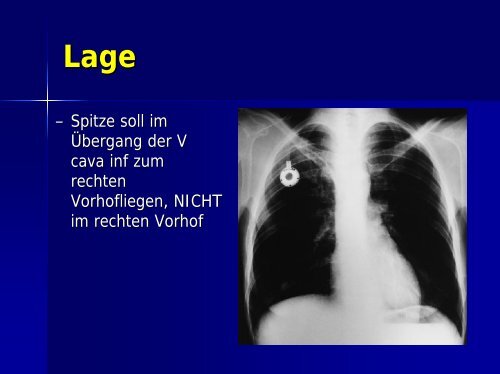 Dauerhafte zentralvenöse Kathetersysteme - AKE