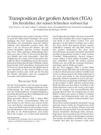 Transposition der großen Arterien (TGA) - Kinderherzstiftung