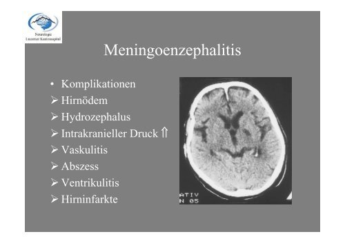 Akute Entzündliche ZNS-Erkrankungen - Luzerner Kantonsspital