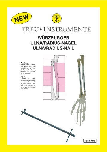 Würzburger Ulna/Radius-Nagel - Treu-Instrumente GmbH