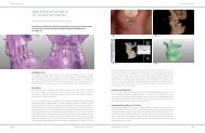 Implantatprothetik im Schonverfahren - Champions-Implants
