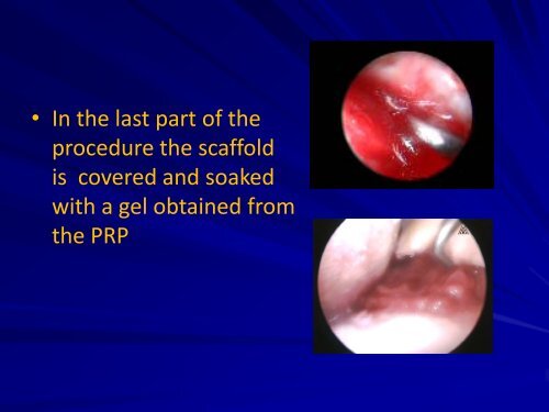 Platelet Rich Plasma (PRP)