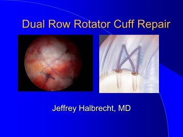 Dual Row Rotator Cuff Repair - IASM