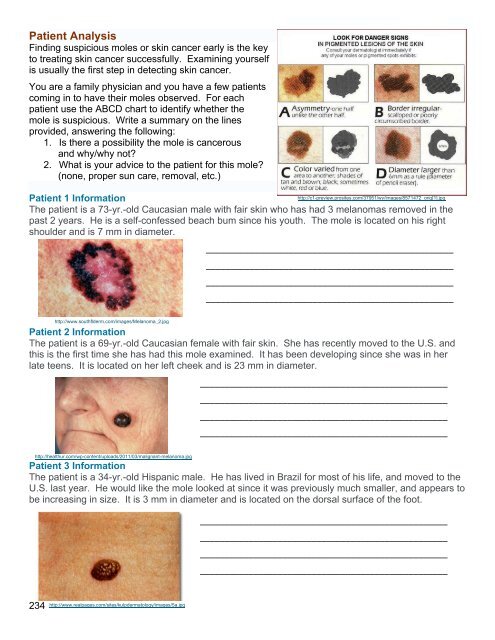 Mole Chart For Skin Cancer