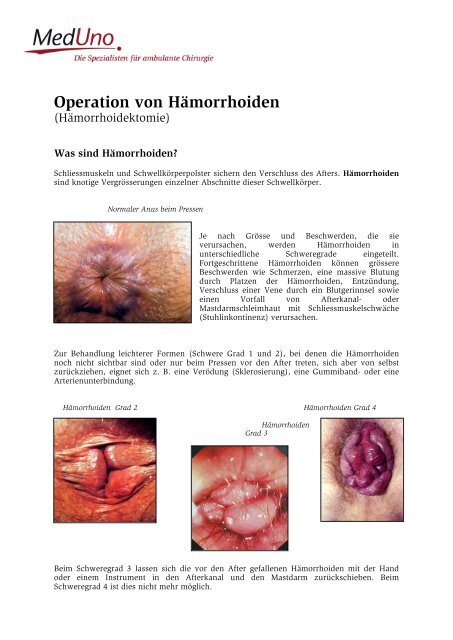Operation von Hämorrhoiden - MedUno