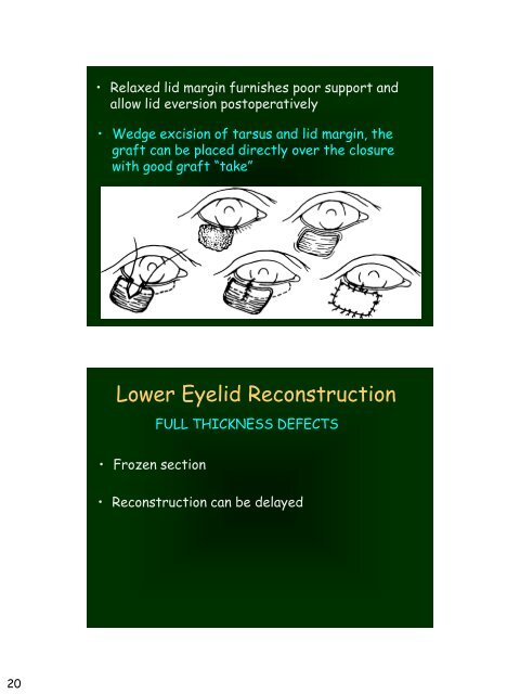 Eyelid Reconstruction