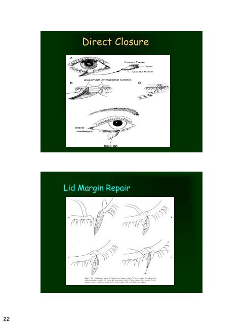 Eyelid Reconstruction