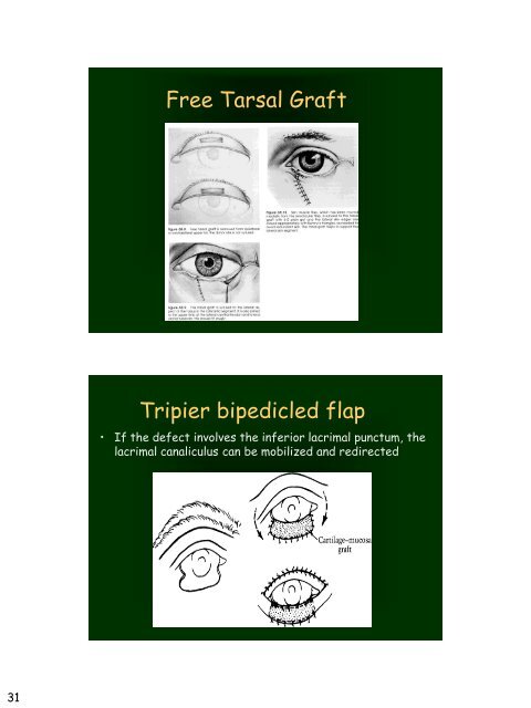 Eyelid Reconstruction