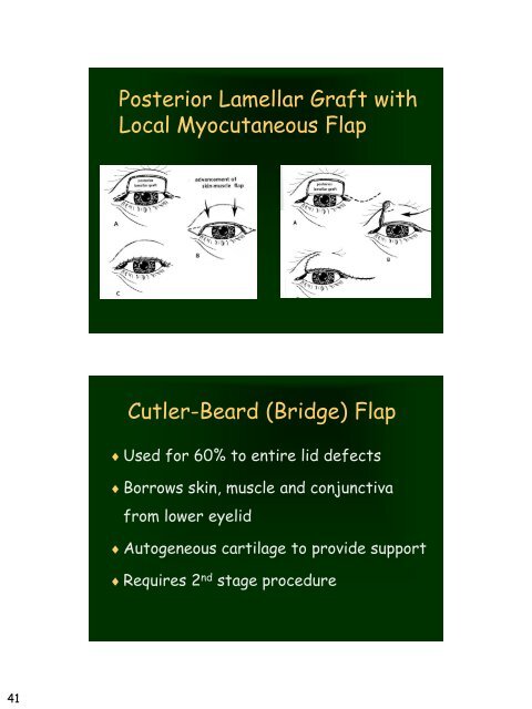 Eyelid Reconstruction