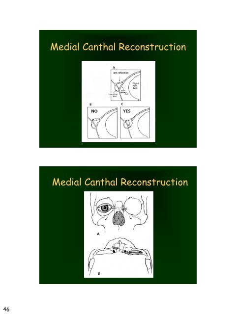 Eyelid Reconstruction