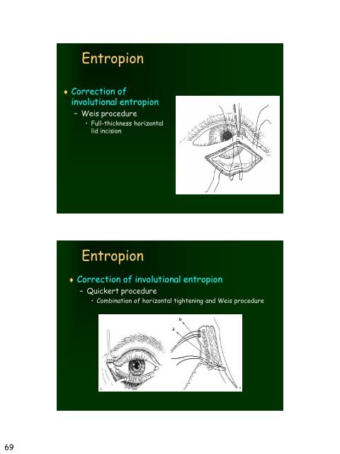 Eyelid Reconstruction