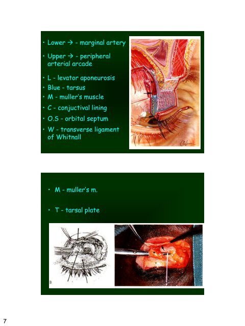 Eyelid Reconstruction