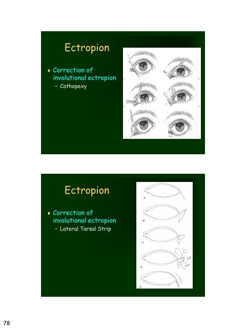 Eyelid Reconstruction