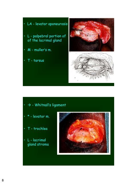 Eyelid Reconstruction