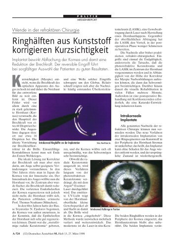 Ringhälften aus Kunststoff korrigieren Kurzsichtigkeit