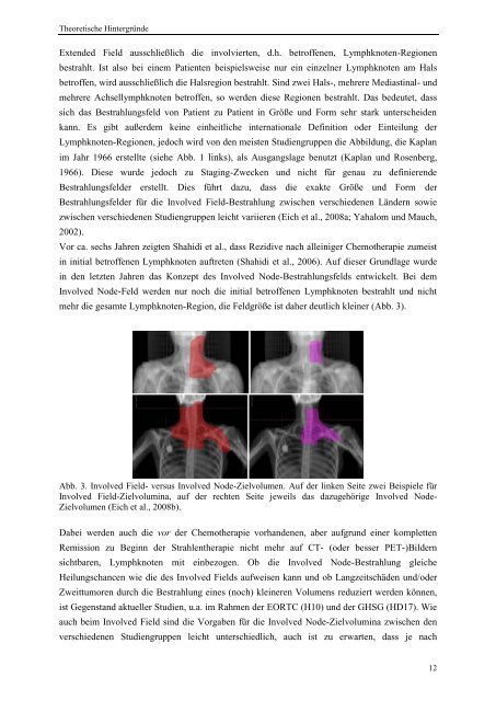 Strahlentherapie des Mediastinalen Hodgkin-Lymphoms