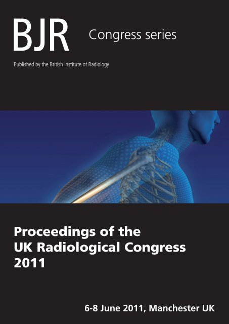 mesothelioma chest x ray