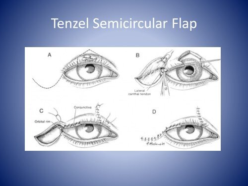 GR Eyelid Reconstruction