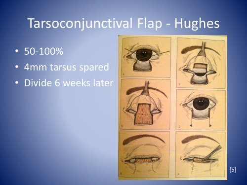 GR Eyelid Reconstruction