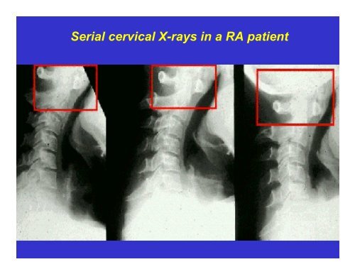 Rheumatoid Arthritis