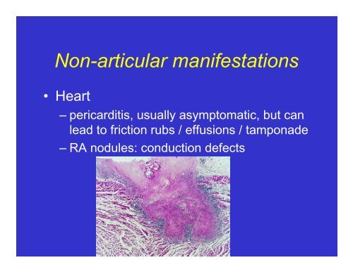 Rheumatoid Arthritis