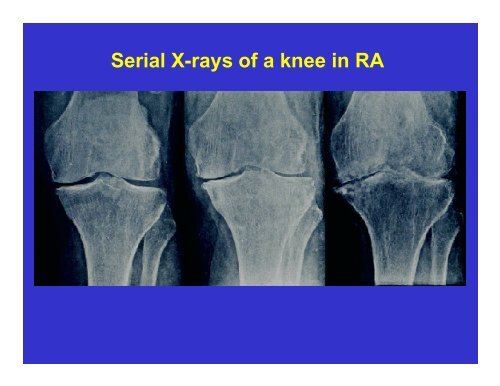 Rheumatoid Arthritis