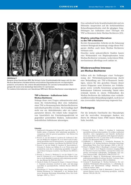 Morbus Bechterew - neue Therapien, offene Fragen - Uniklinik Balgrist