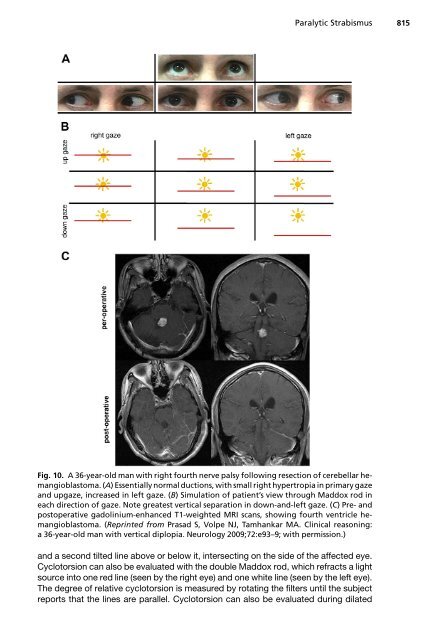 Paralytic Strabismus: Third, Fourth, and Sixth Nerve Palsy