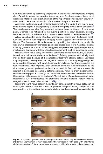 Paralytic Strabismus: Third, Fourth, and Sixth Nerve Palsy